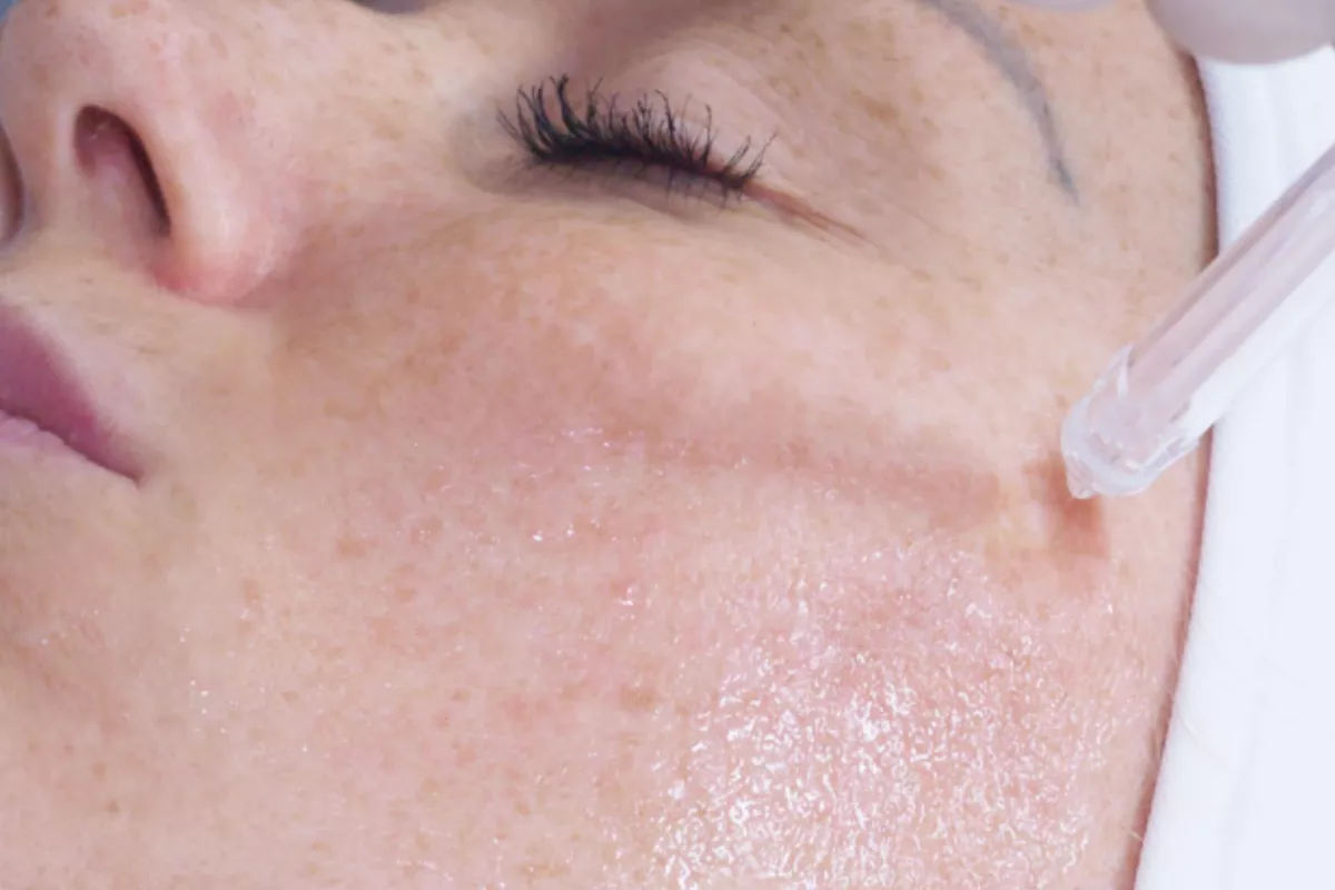 Nettoyage jetpeel de la pommette d'un visage féminin