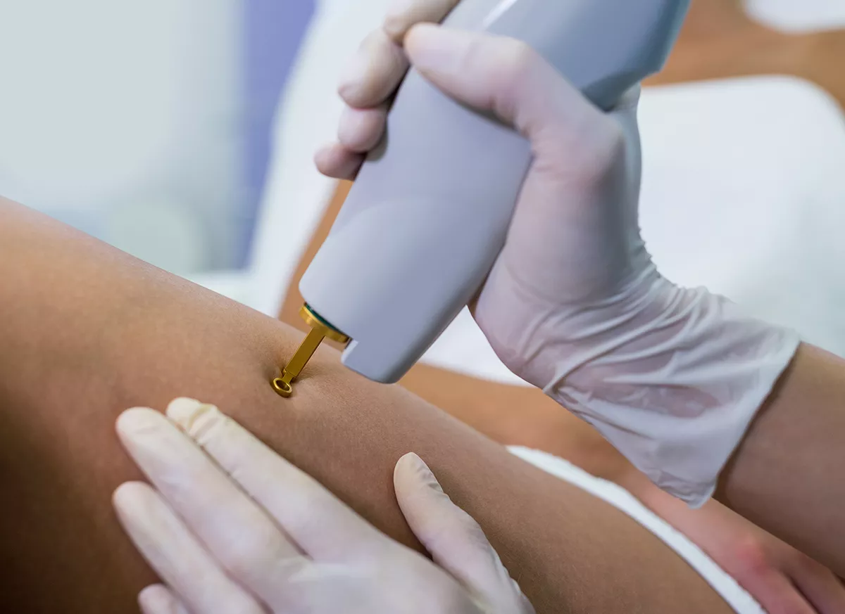 Traitement des varicosités des jambes au laser